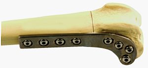 顆上骨折プレート