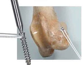 スーチャーアンカーピン - 2本セット